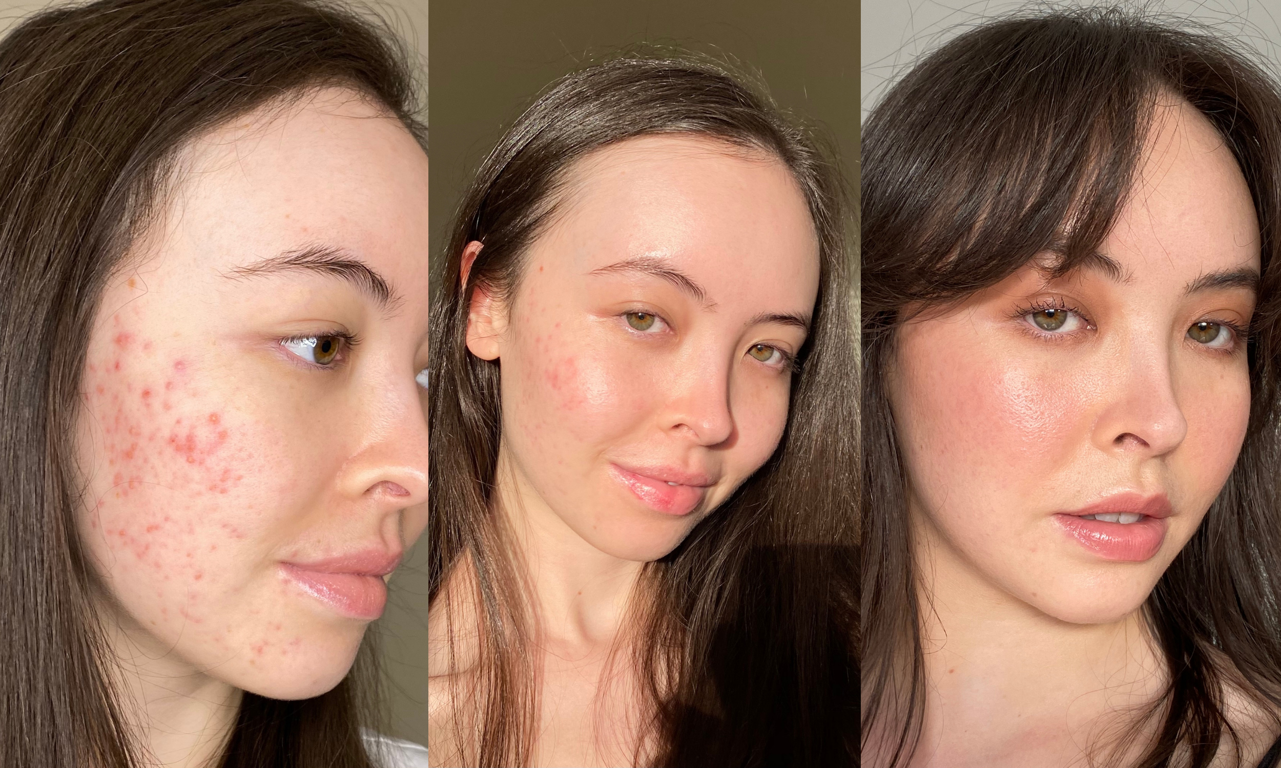 Three pictures of Emily (@sunshineskin) and her journey with acne.