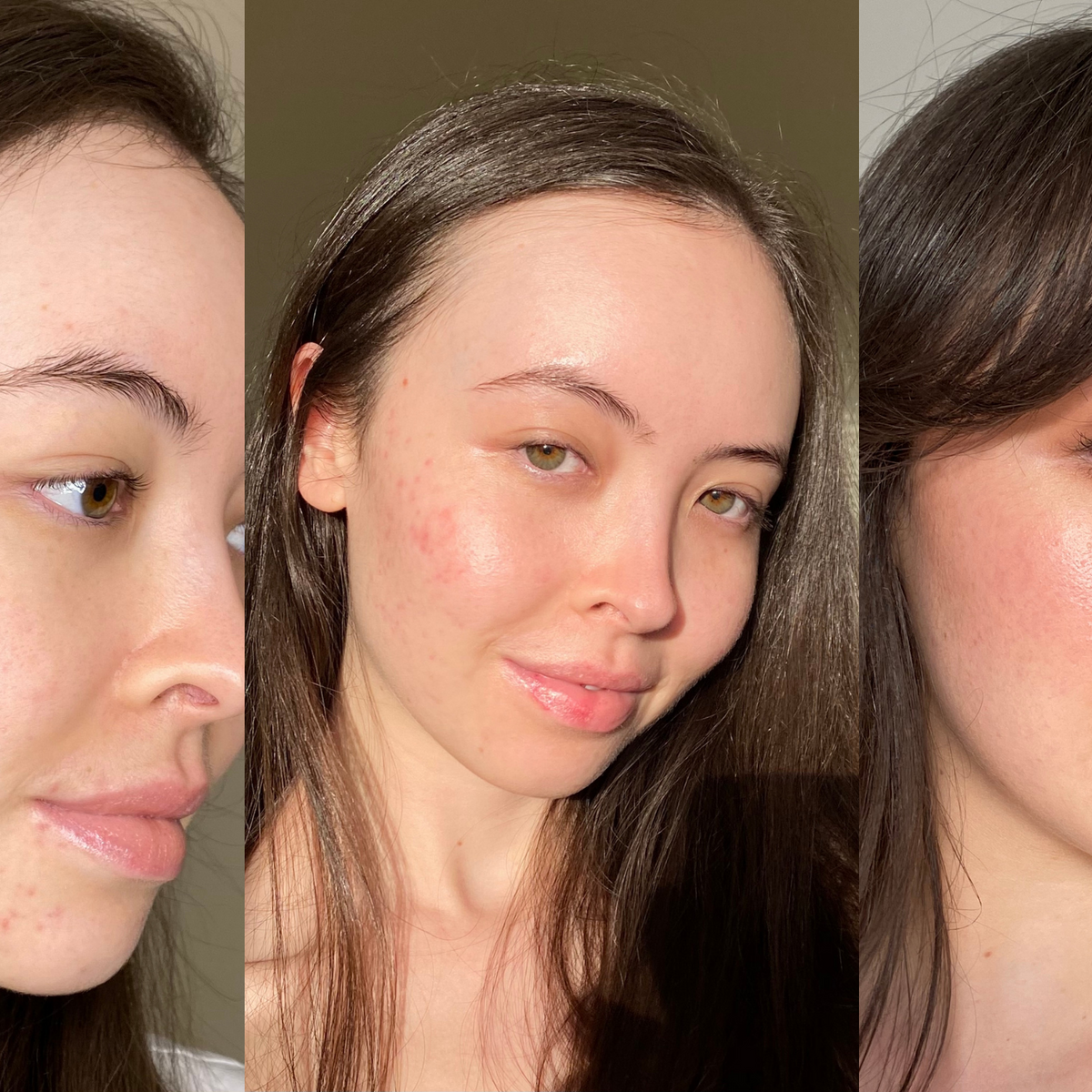 Perfectly Imperfect Skin: A Journey of Acne and Self Love By @sunshine