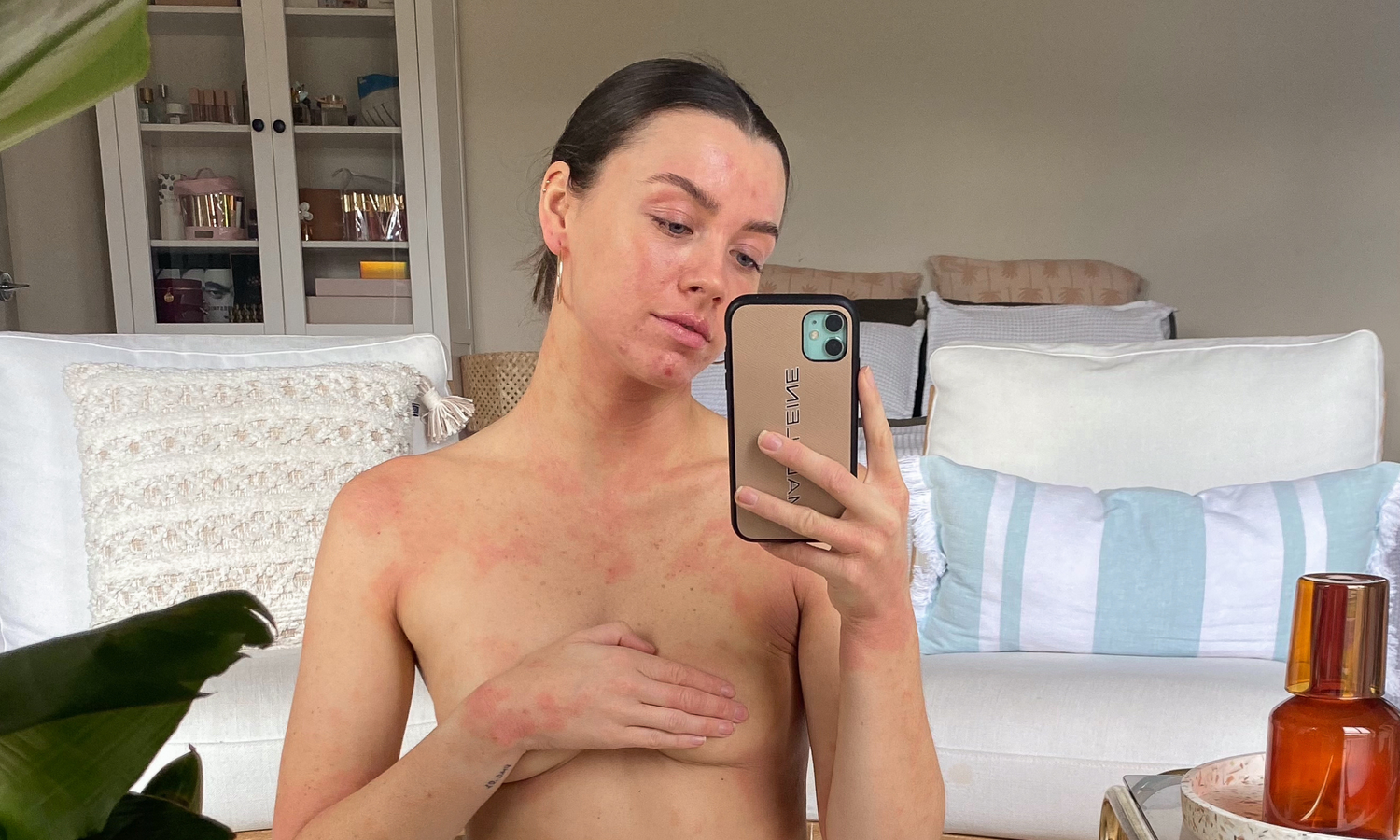 Maddie Edwards sitting with an Eczema flare up on her chest and arms.